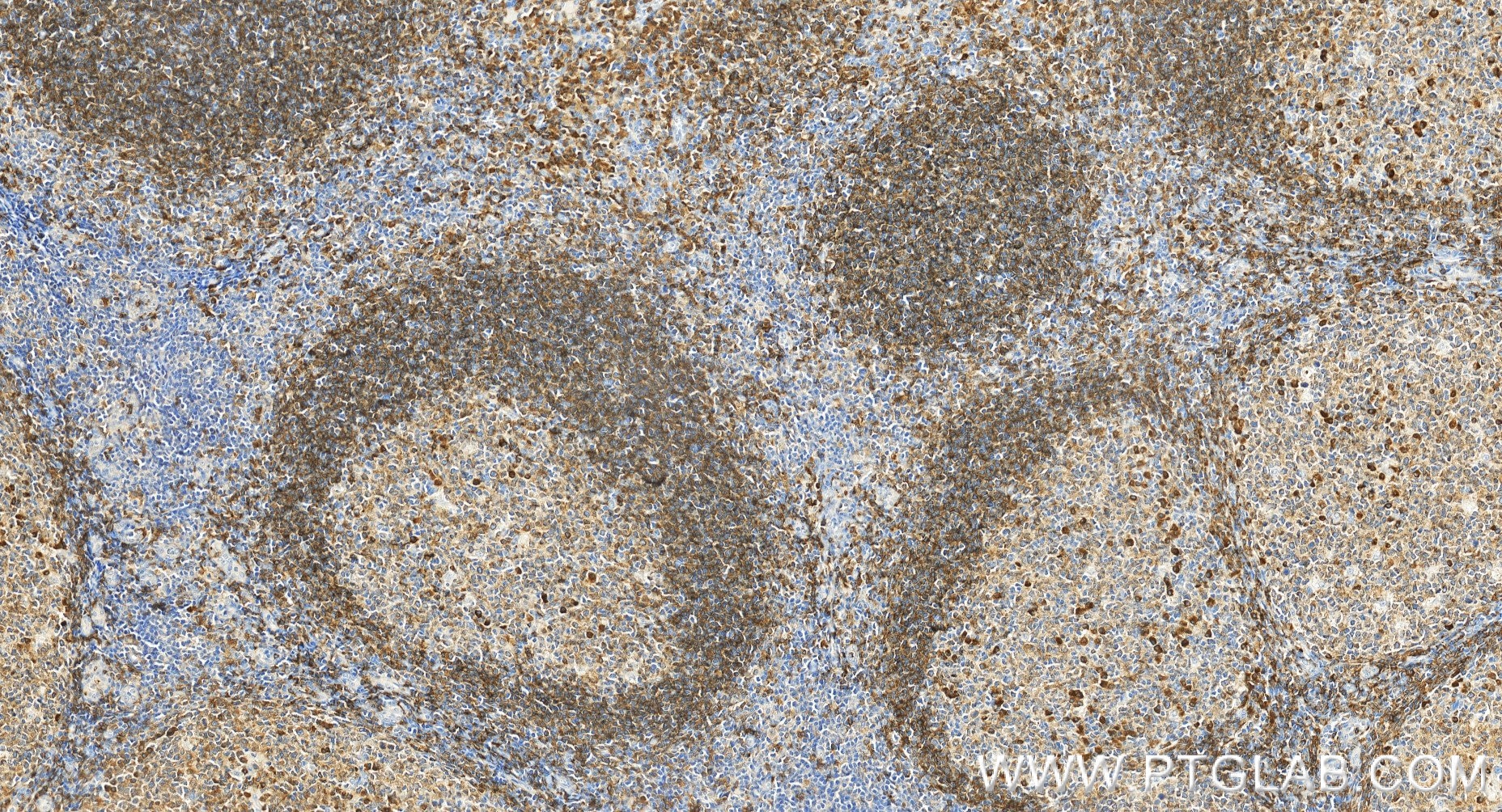 Immunohistochemistry (IHC) staining of human tonsillitis tissue using Anti-Human CD79a Rabbit Recombinant Antibody (98072-1-RR)