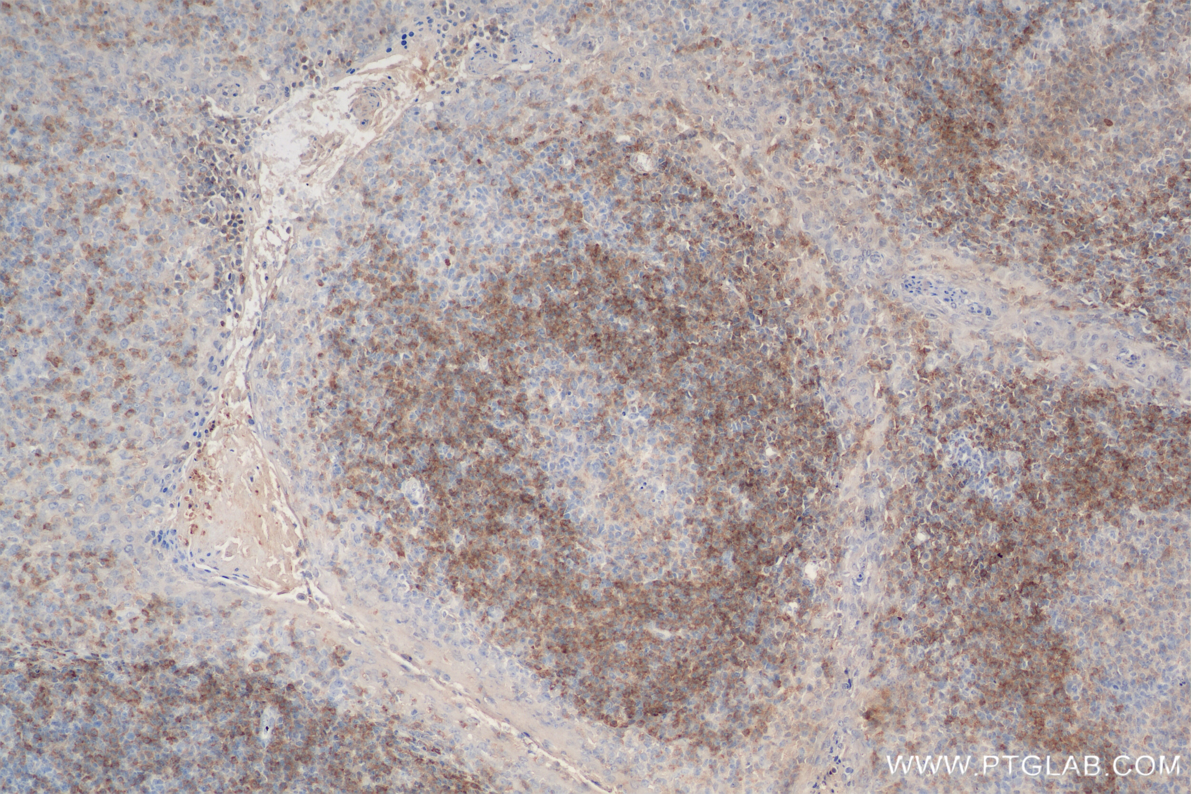 Immunohistochemistry (IHC) staining of human tonsillitis tissue using CD79b Recombinant antibody (84234-5-RR)