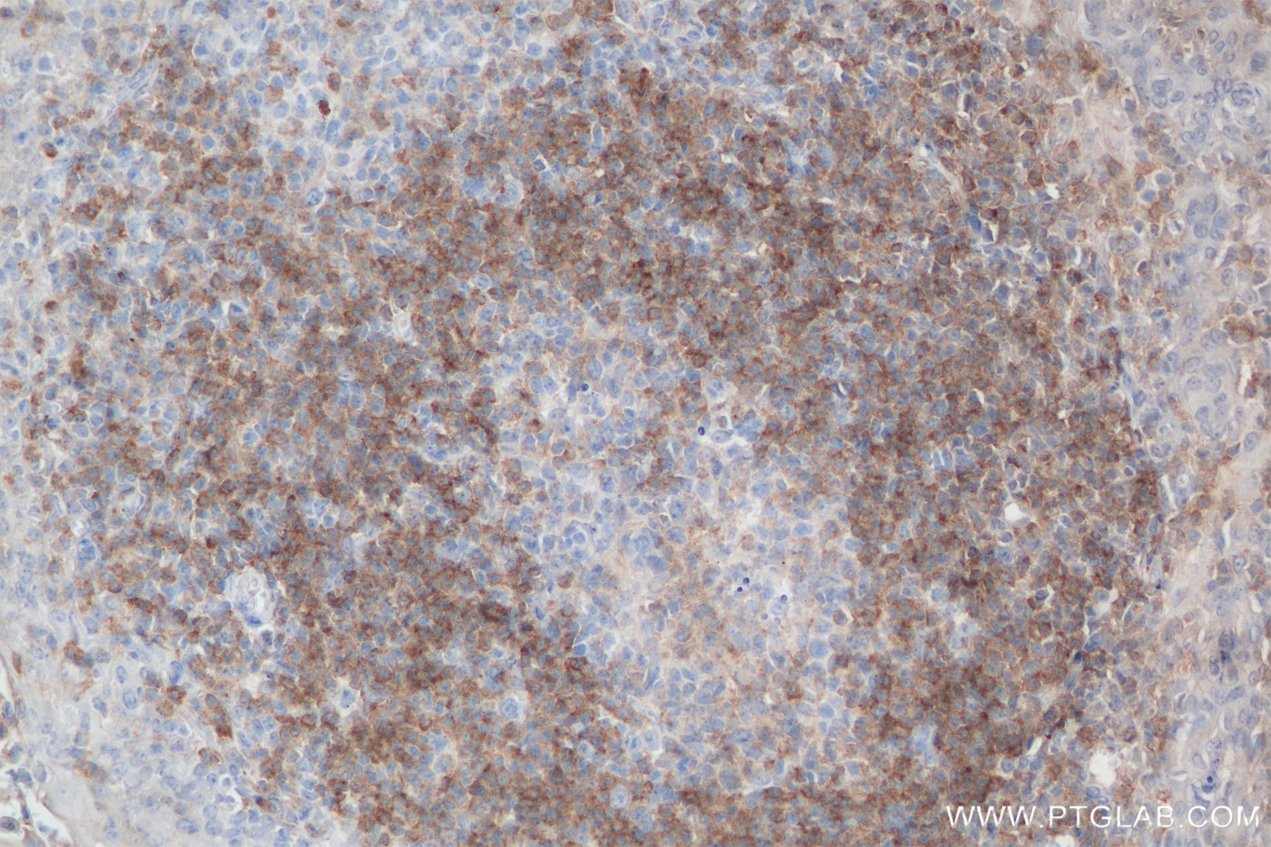 Immunohistochemistry (IHC) staining of human tonsillitis tissue using CD79b Recombinant antibody (84234-5-RR)