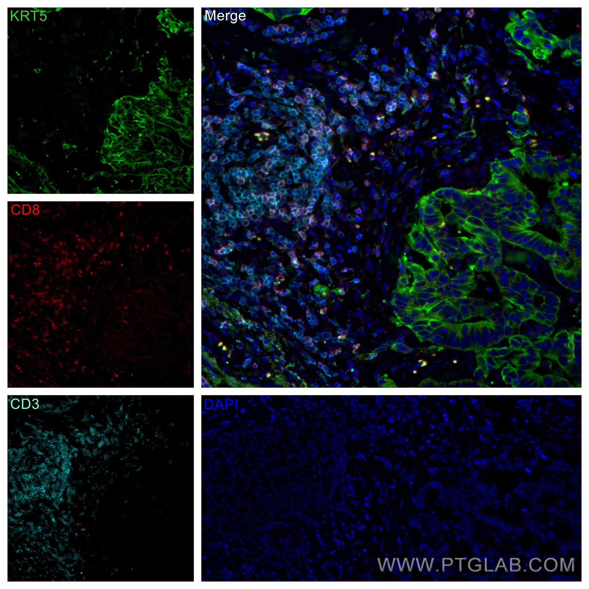 Immunofluorescence (IF) / fluorescent staining of human colon cancer tissue using CoraLite®594-conjugated CD8a Monoclonal antibody (CL594-66868)