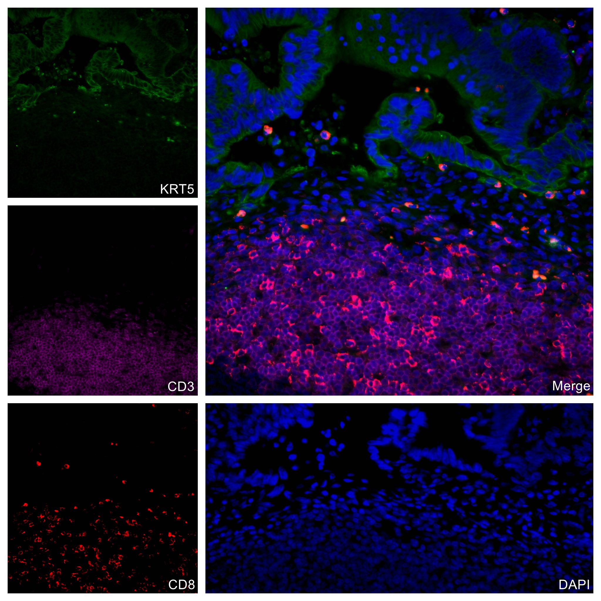 Immunofluorescence (IF) / fluorescent staining of human colon cancer tissue using CoraLite®594-conjugated CD8a Monoclonal antibody (CL594-66868)
