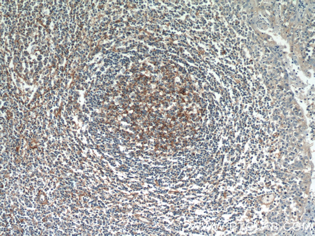 Immunohistochemistry (IHC) staining of human tonsillitis tissue using CD81 Polyclonal antibody (18250-1-AP)