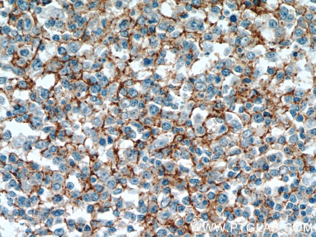 IHC staining of human tonsillitis using 18250-1-AP