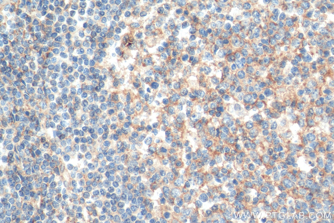 Immunohistochemistry (IHC) staining of human tonsillitis tissue using CD81 Monoclonal antibody (66866-1-Ig)