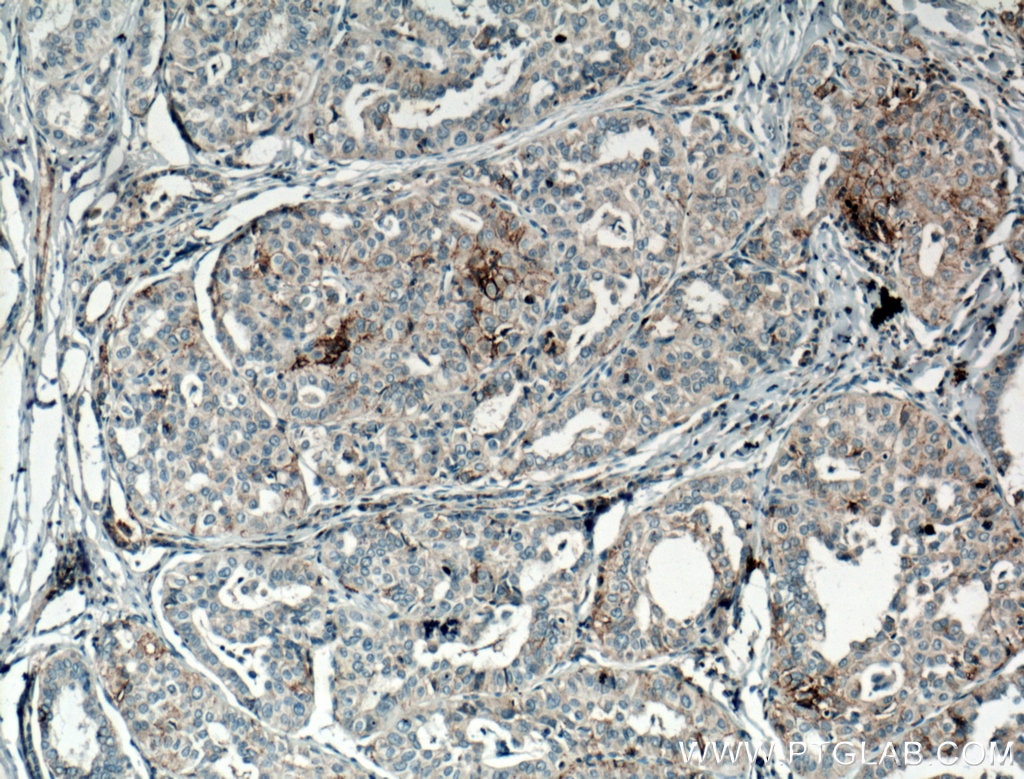 Immunohistochemistry (IHC) staining of human thyroid cancer tissue using CD82 Polyclonal antibody (10248-1-AP)