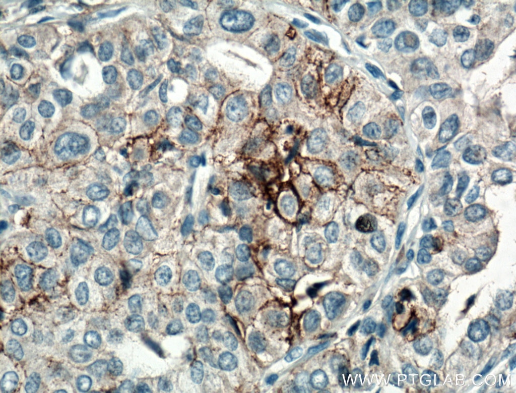 Immunohistochemistry (IHC) staining of human thyroid cancer tissue using CD82 Polyclonal antibody (10248-1-AP)