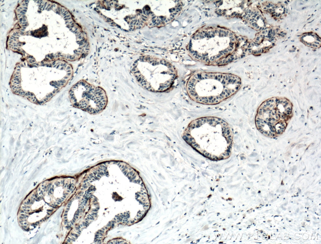 Immunohistochemistry (IHC) staining of human breast cancer tissue using CD82 Polyclonal antibody (10248-1-AP)