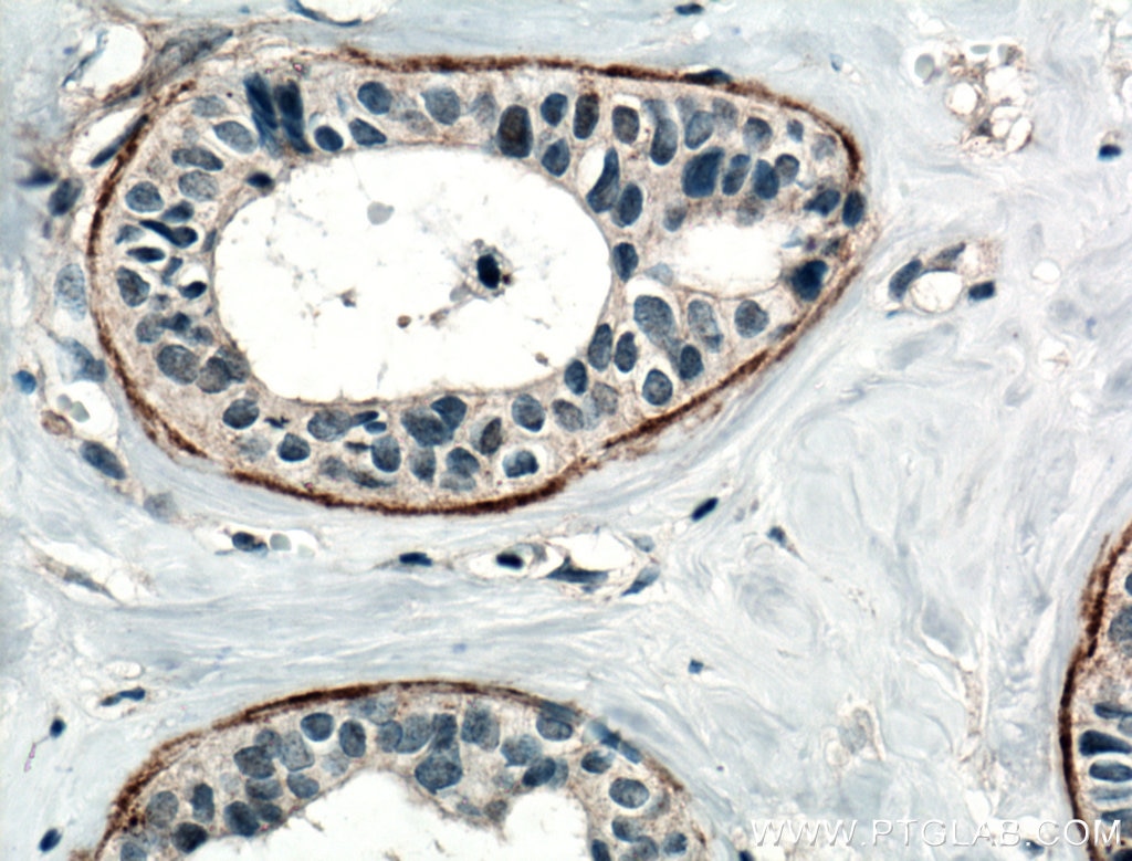 Immunohistochemistry (IHC) staining of human breast cancer tissue using CD82 Polyclonal antibody (10248-1-AP)