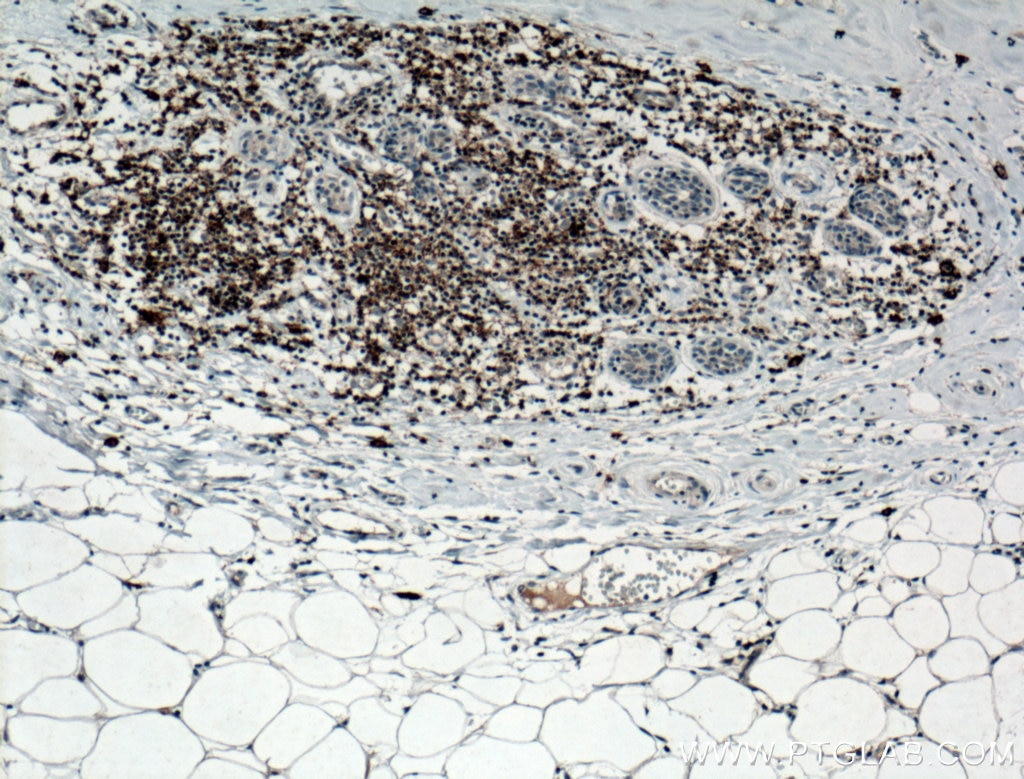 Immunohistochemistry (IHC) staining of human thyroid cancer tissue using CD82 Polyclonal antibody (10248-1-AP)