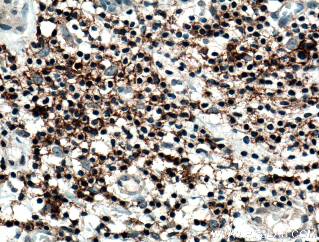 Immunohistochemistry (IHC) staining of human thyroid cancer tissue using CD82 Polyclonal antibody (10248-1-AP)