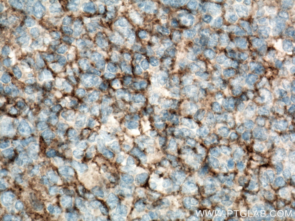 IHC staining of human tonsillitis using 10248-1-AP