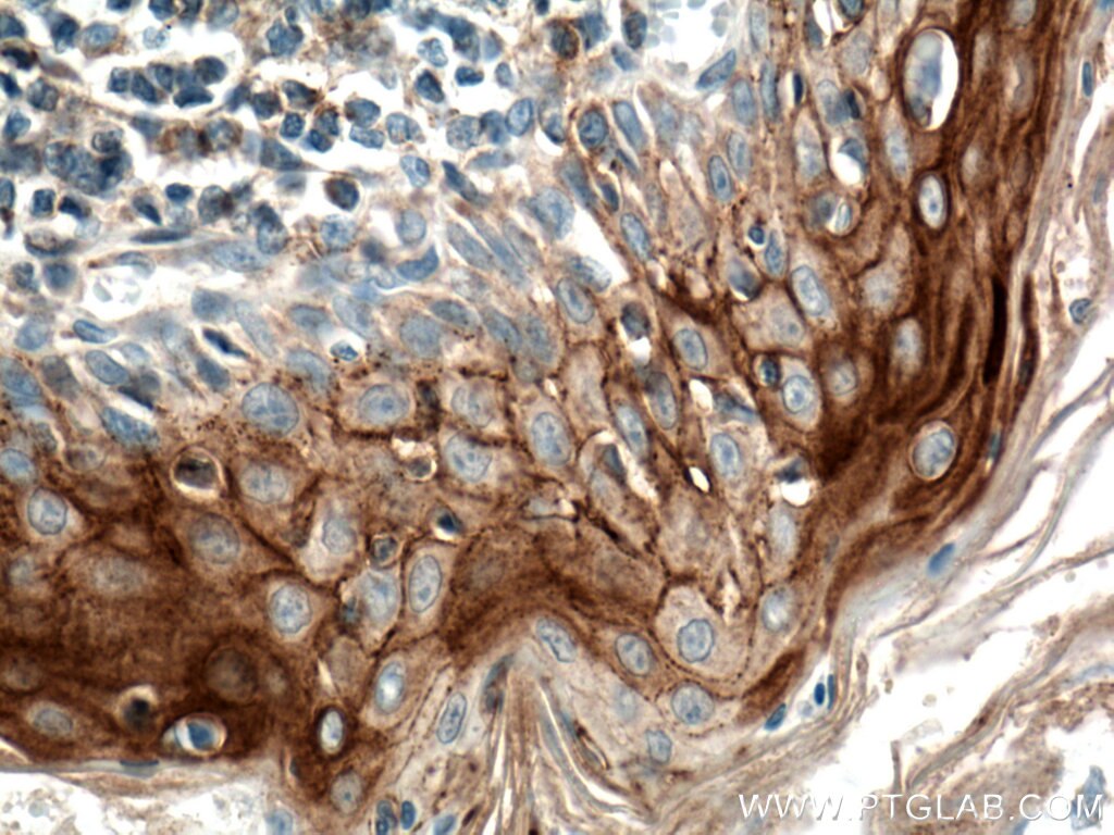 Immunohistochemistry (IHC) staining of human tonsillitis tissue using CD82 Monoclonal antibody (66803-1-Ig)