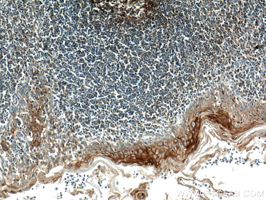 Immunohistochemistry (IHC) staining of human tonsillitis tissue using CD82 Monoclonal antibody (66803-1-Ig)
