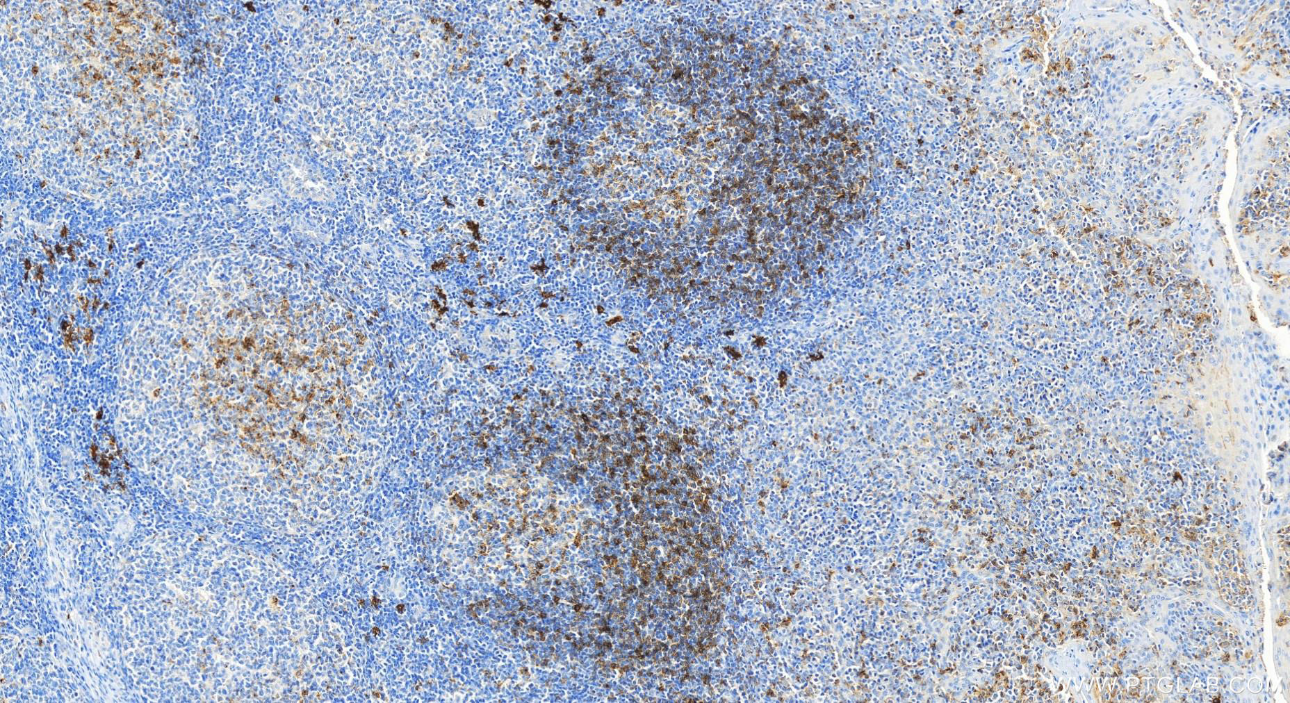 Immunohistochemistry (IHC) staining of human tonsillitis tissue using CD83 Polyclonal antibody (27873-1-AP)