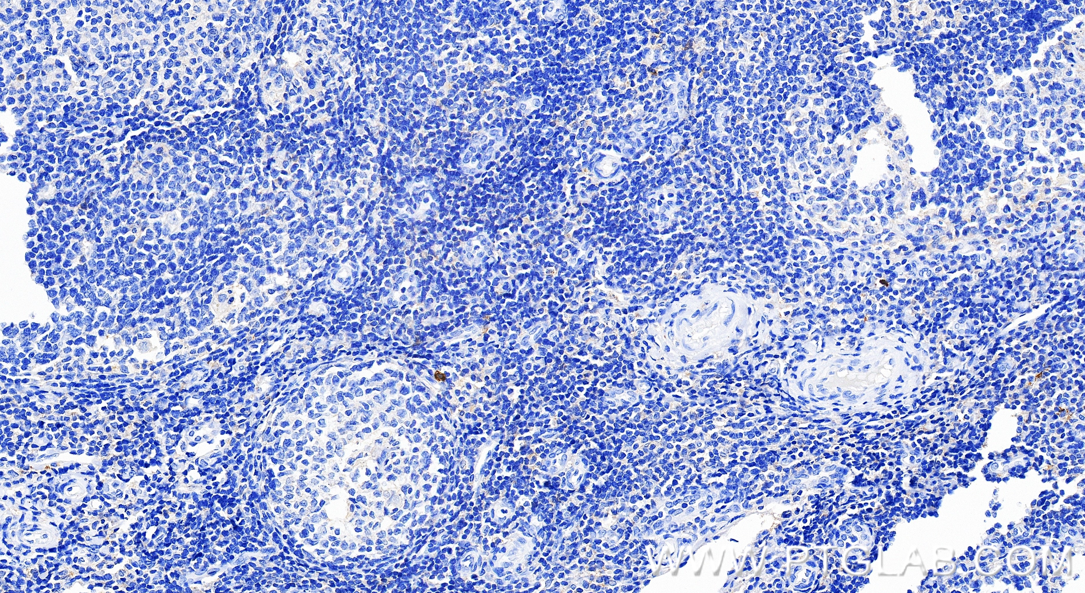 IHC staining of human tonsillitis using 98471-1-RR (same clone as 98471-1-PBS) Immunohistochemistry (IHC) staining of human tonsillitis tissue using Anti-Human CD85j / LILRB1 Rabbit Recombinant Antib (98471-1-RR)