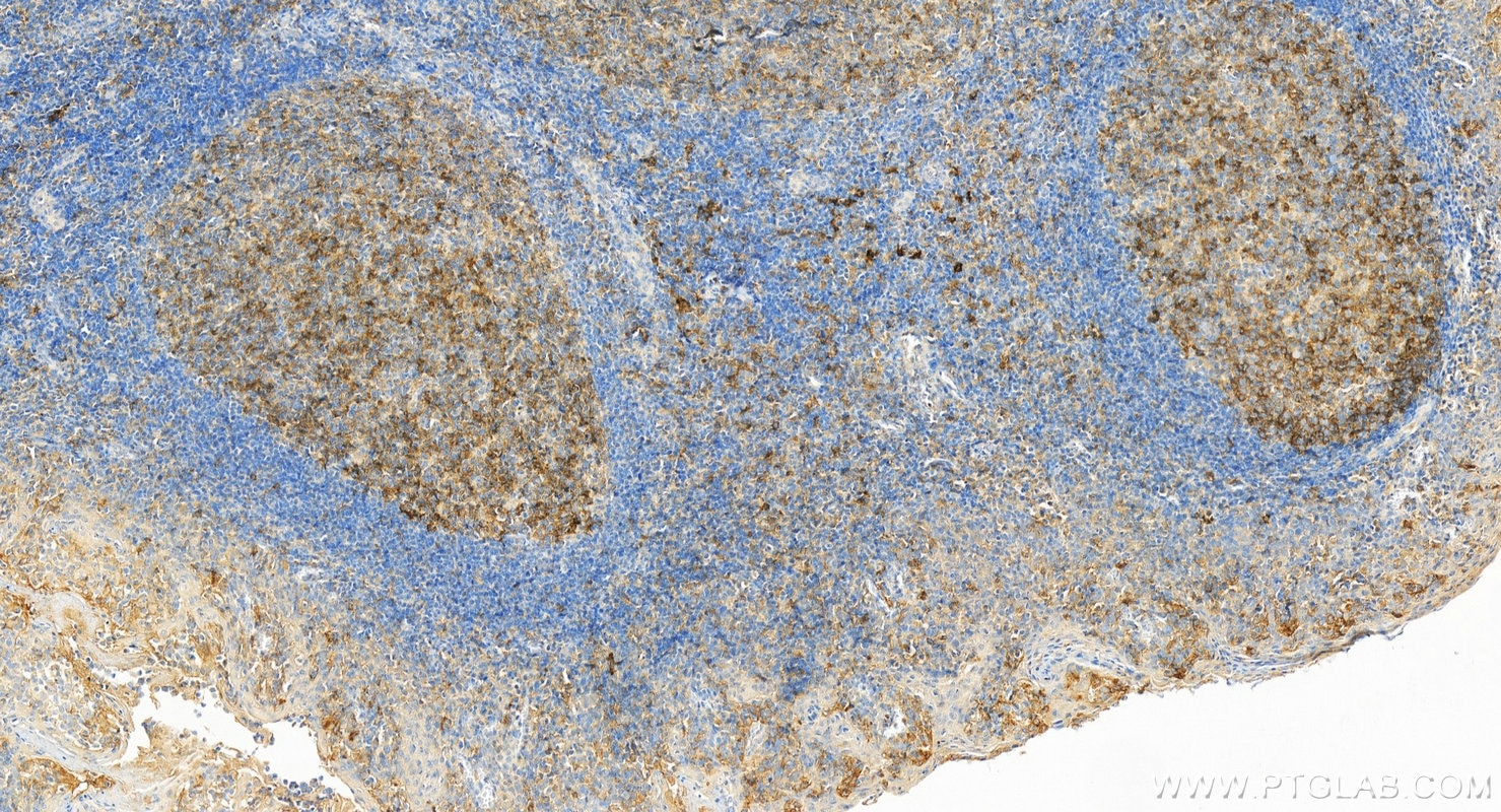 Immunohistochemistry (IHC) staining of human tonsillitis tissue using CD86 (C-terminal) Polyclonal antibody (26903-1-AP)