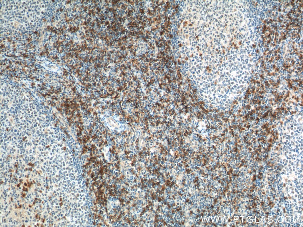 IHC staining of human tonsillitis using 17335-1-AP