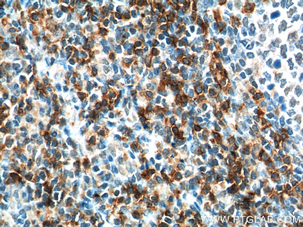 Immunohistochemistry (IHC) staining of human tonsillitis tissue using CD8a Polyclonal antibody (17335-1-AP)