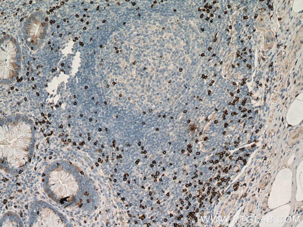 Immunohistochemistry (IHC) staining of human appendicitis tissue using CD8a Monoclonal antibody (66868-1-Ig)