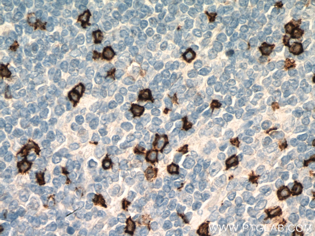 Immunohistochemistry (IHC) staining of human appendicitis tissue using CD8 Monoclonal antibody (66868-1-Ig)