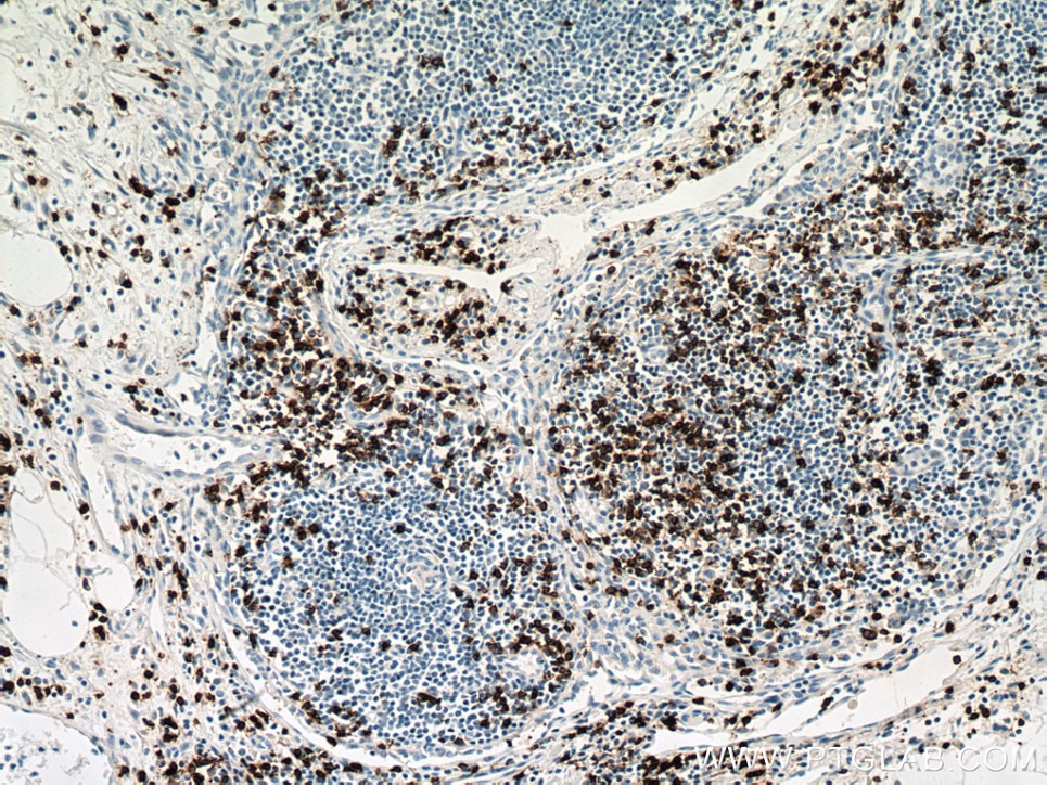 Immunohistochemistry (IHC) staining of human pancreas cancer tissue using CD8a Monoclonal antibody (66868-1-Ig)