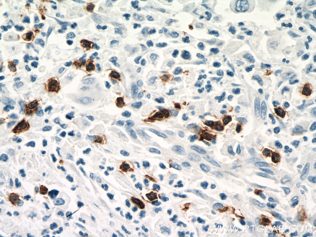 Immunohistochemistry (IHC) staining of human pancreas cancer tissue using CD8a Monoclonal antibody (66868-1-Ig)