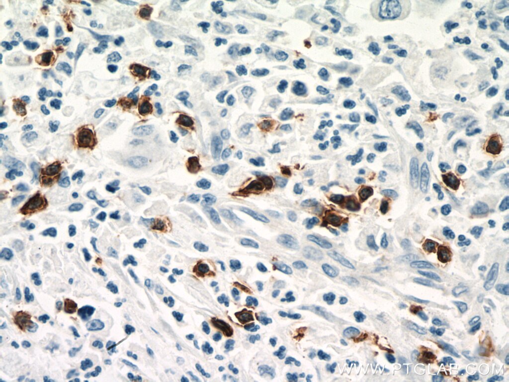 IHC staining of human pancreas cancer using 66868-1-Ig