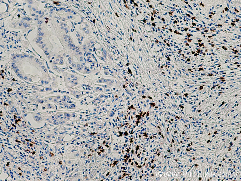 Immunohistochemistry (IHC) staining of human pancreas cancer tissue using CD8 Monoclonal antibody (66868-1-Ig)