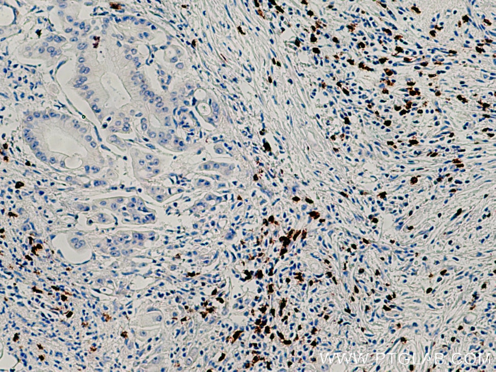 Immunohistochemistry (IHC) staining of human pancreas cancer tissue using CD8a Monoclonal antibody (66868-1-Ig)