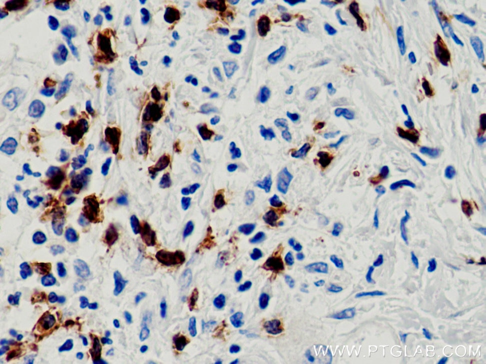 IHC staining of human pancreas cancer using 66868-1-Ig