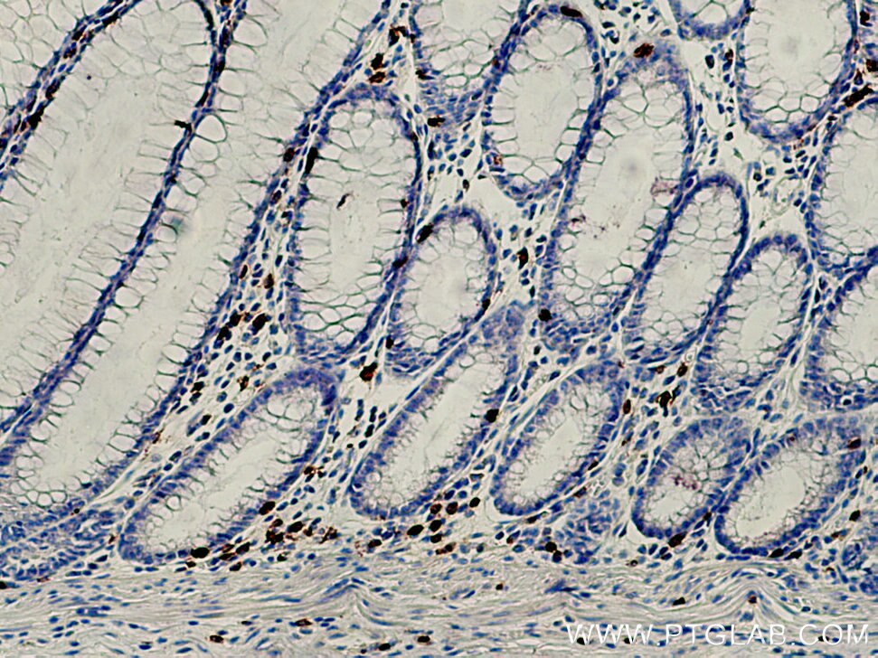 Immunohistochemistry (IHC) staining of human colon cancer tissue using CD8a Monoclonal antibody (66868-1-Ig)