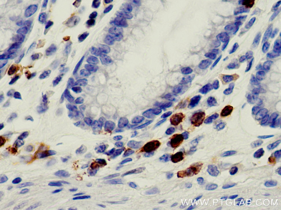 Immunohistochemistry (IHC) staining of human colon cancer tissue using CD8a Monoclonal antibody (66868-1-Ig)
