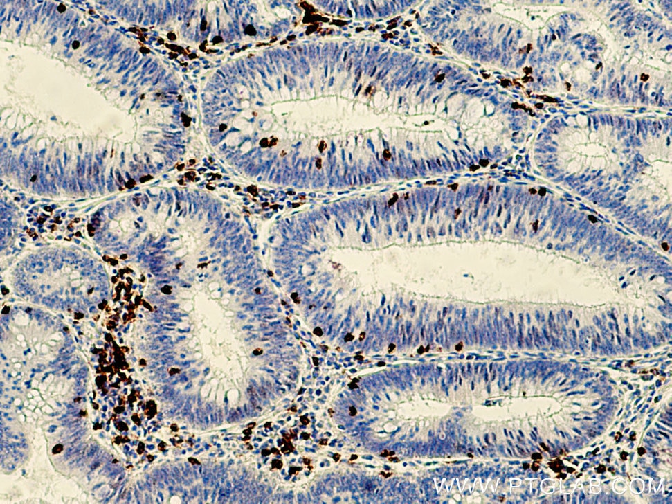 Immunohistochemistry (IHC) staining of human colon cancer tissue using CD8a Monoclonal antibody (66868-1-Ig)