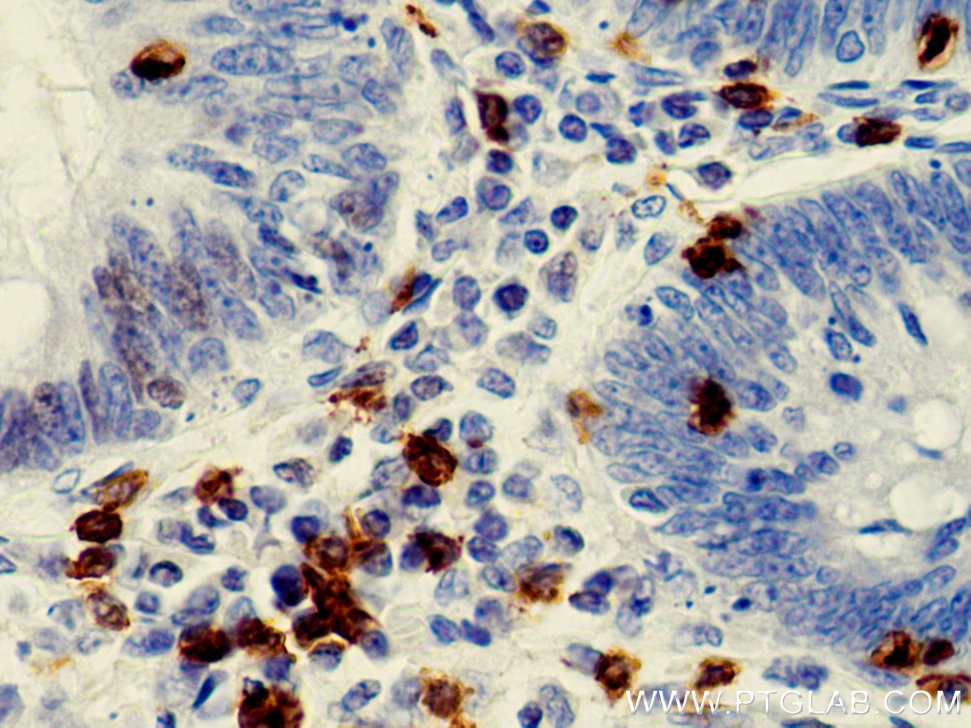 IHC staining of human colon cancer using 66868-1-Ig