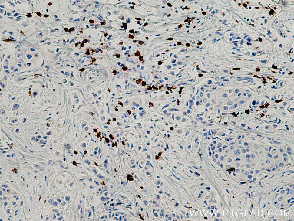 Immunohistochemistry (IHC) staining of human breast cancer tissue using CD8a Monoclonal antibody (66868-1-Ig)