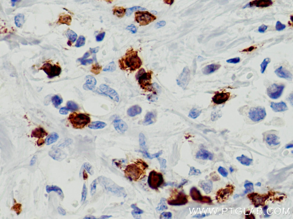Immunohistochemistry (IHC) staining of human breast cancer tissue using CD8 Monoclonal antibody (66868-1-Ig)