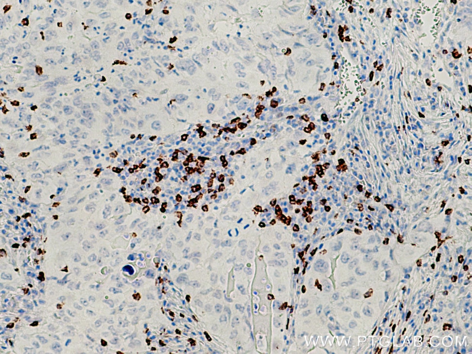Immunohistochemistry (IHC) staining of human lung cancer tissue using CD8 Monoclonal antibody (66868-1-Ig)