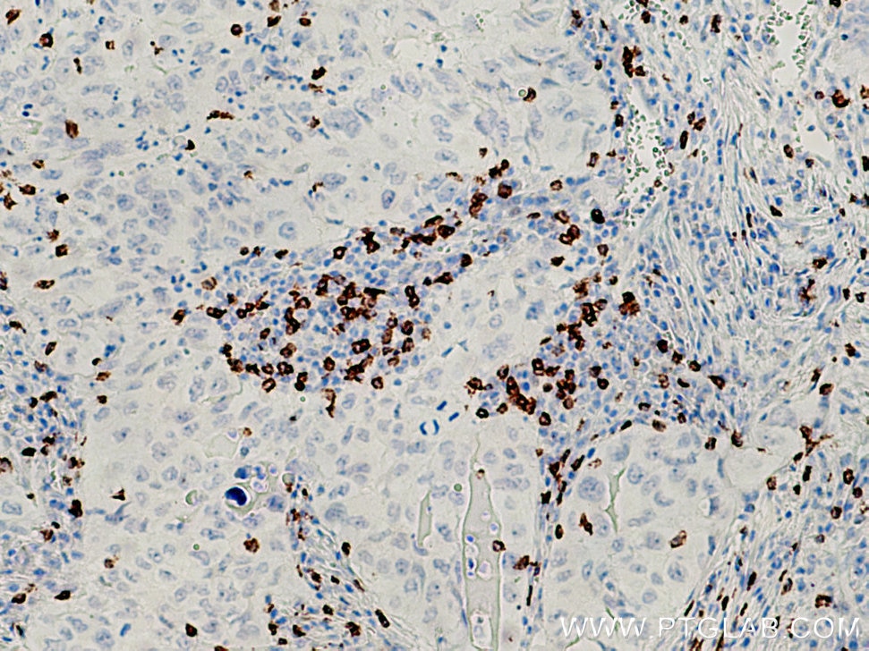 IHC staining of human lung cancer using 66868-1-Ig