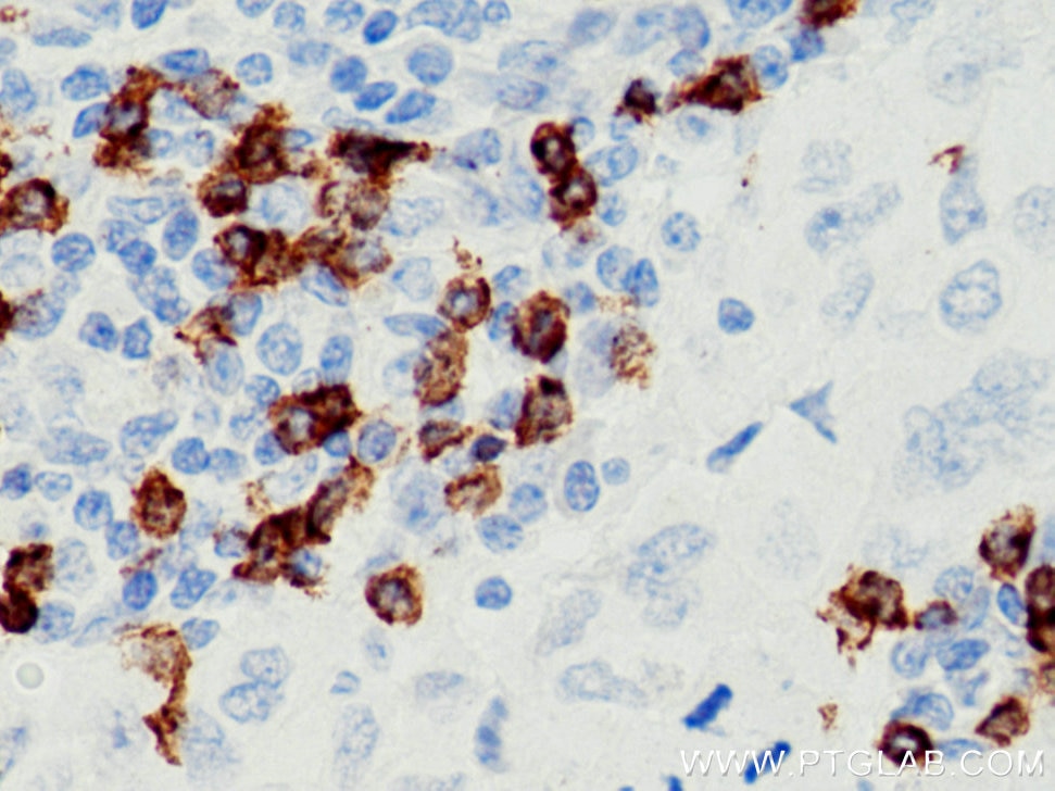 Immunohistochemistry (IHC) staining of human lung cancer tissue using CD8a Monoclonal antibody (66868-1-Ig)