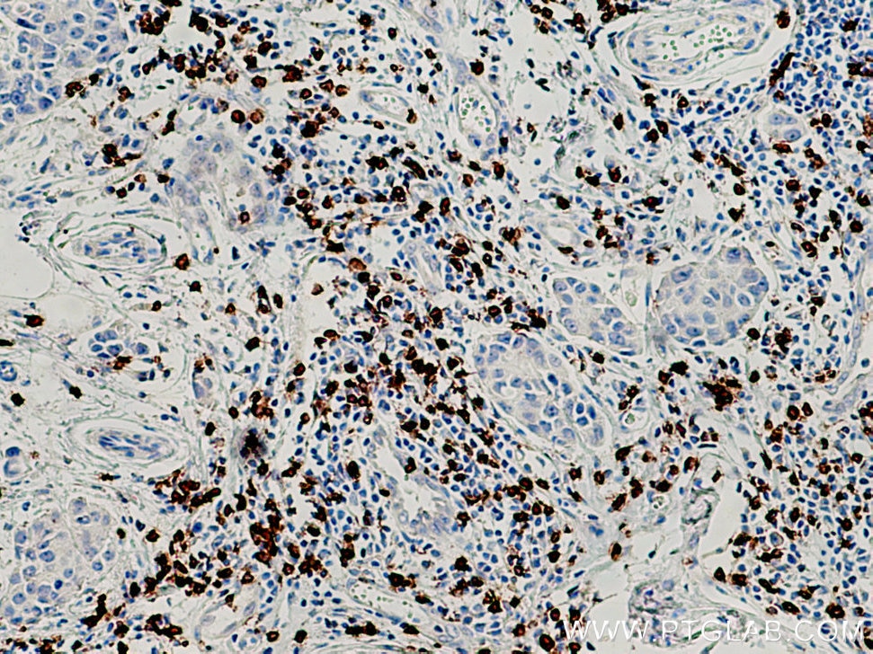 IHC staining of human breast cancer using 66868-1-Ig