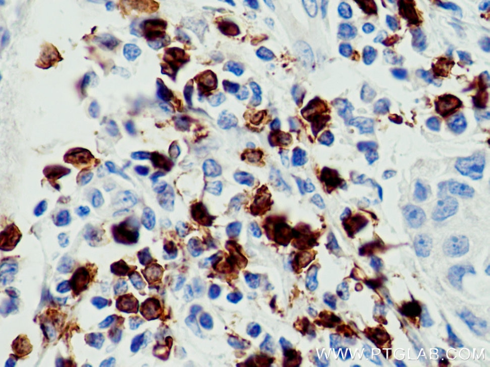 Immunohistochemistry (IHC) staining of human breast cancer tissue using CD8a Monoclonal antibody (66868-1-Ig)