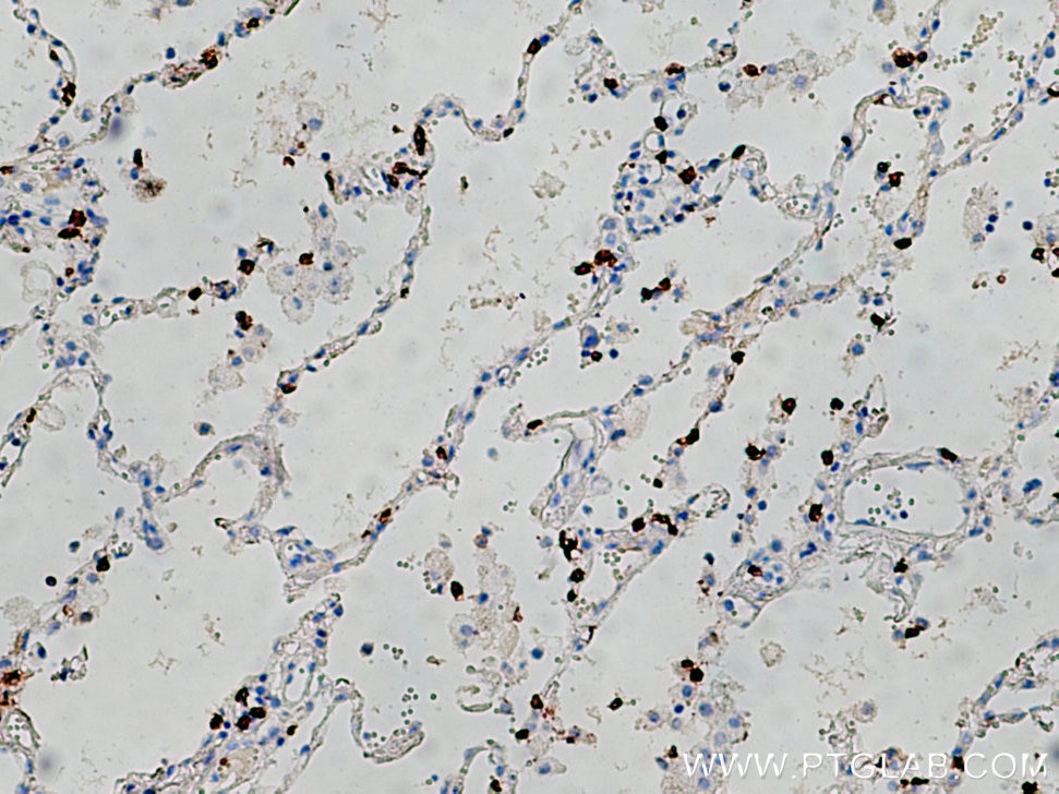 Immunohistochemistry (IHC) staining of human lung cancer tissue using CD8a Monoclonal antibody (66868-1-Ig)