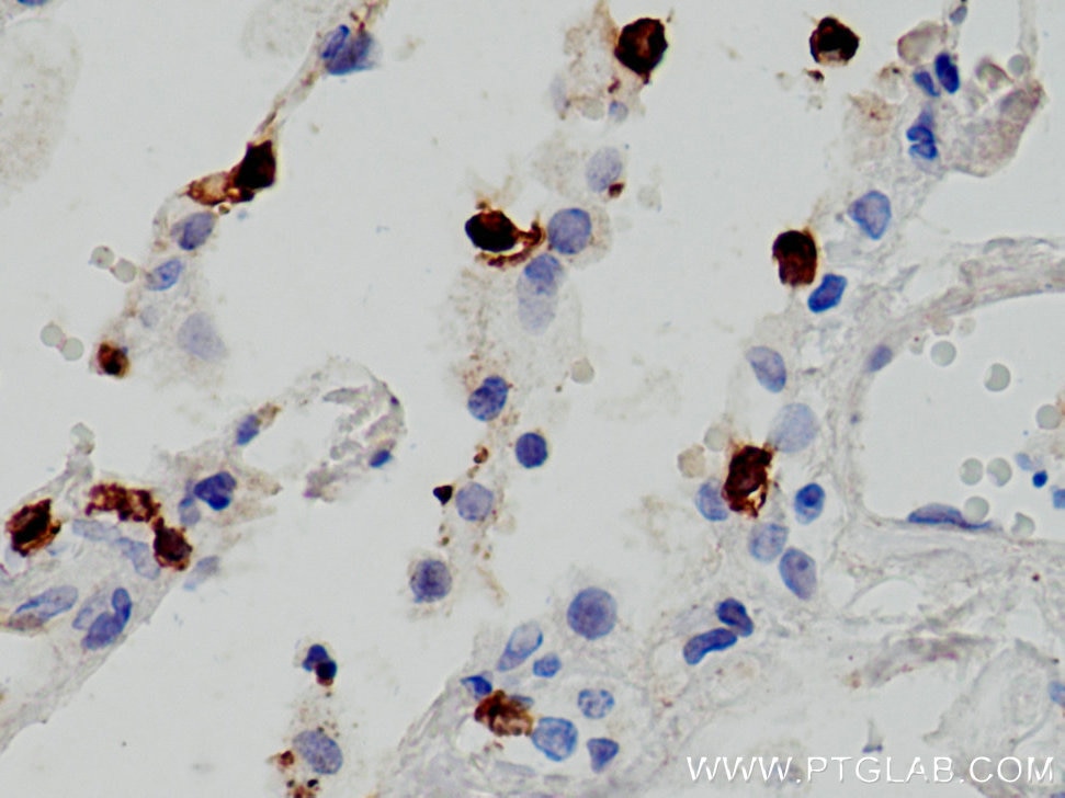 Immunohistochemistry (IHC) staining of human lung cancer tissue using CD8a Monoclonal antibody (66868-1-Ig)