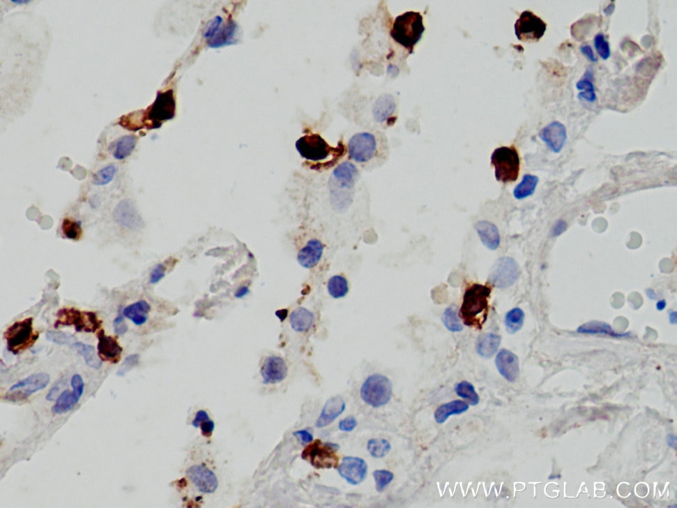 IHC staining of human lung cancer using 66868-1-Ig