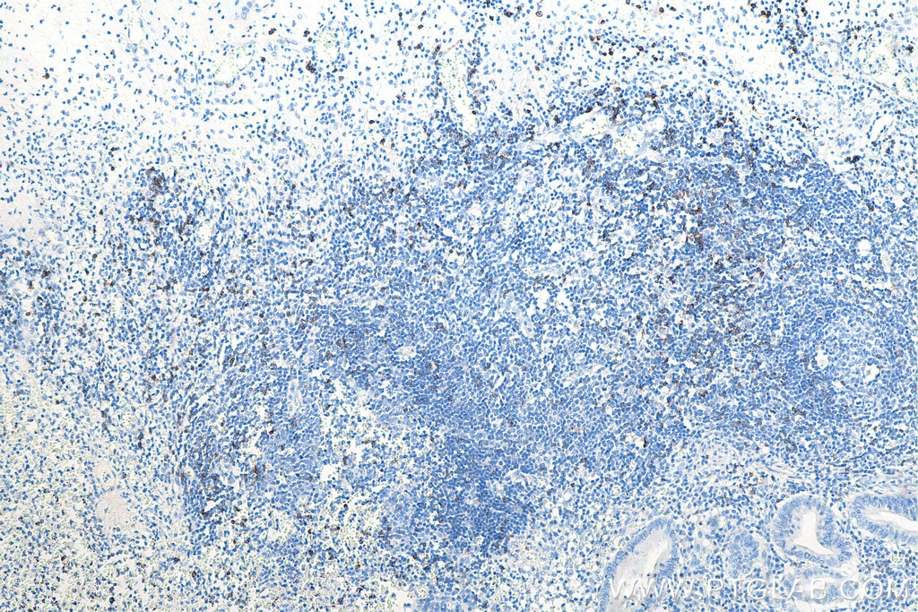 IHC staining of human appendicitis using 66868-1-Ig Immunohistochemistry (IHC) staining of human appendicitis tissue using CD8a Monoclonal antibody (66868-1-Ig)