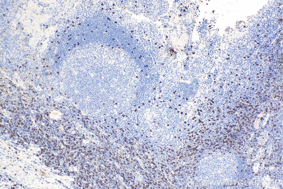 Immunohistochemistry (IHC) staining of human tonsillitis tissue using CD8a Monoclonal antibody (66868-1-Ig)