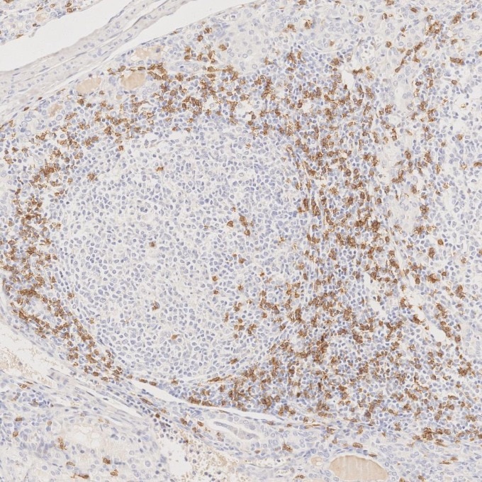 Immunohistochemistry (IHC) staining of human lymphoma tissue using CD8a Monoclonal antibody (66868-1-Ig)