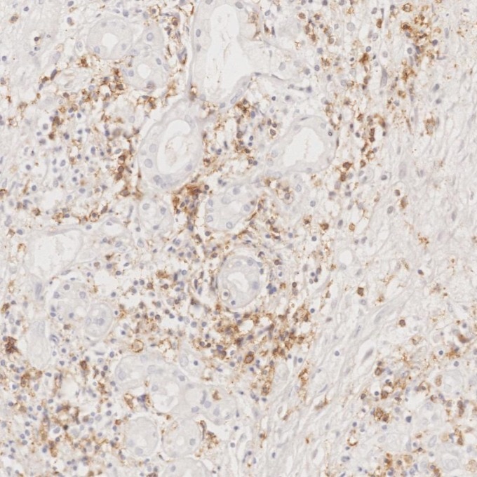 Immunohistochemistry (IHC) staining of human lymphoma tissue using CD8a Monoclonal antibody (66868-1-Ig)