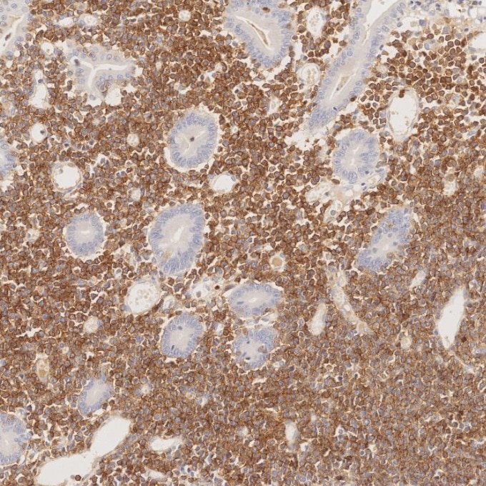 Immunohistochemistry (IHC) staining of human lymphoma tissue using CD8a Monoclonal antibody (66868-1-Ig)