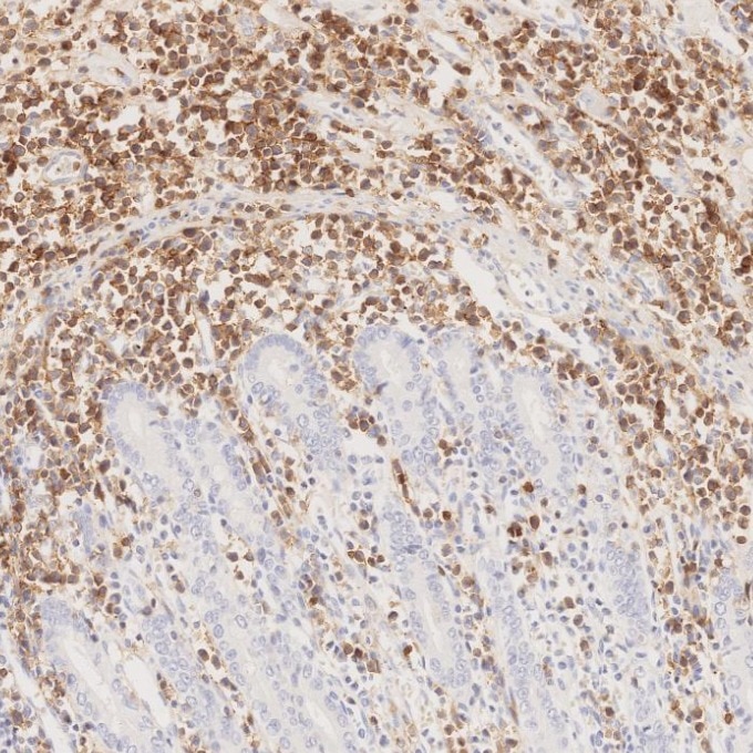 Immunohistochemistry (IHC) staining of human lymphoma tissue using CD8a Monoclonal antibody (66868-1-Ig)